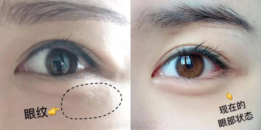 黑眼圈|blingbling大眼秘诀！早晚滚两下，赶走黑眼圈、细干纹！