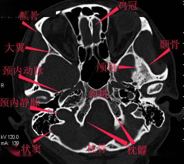 颅底详细断层解剖