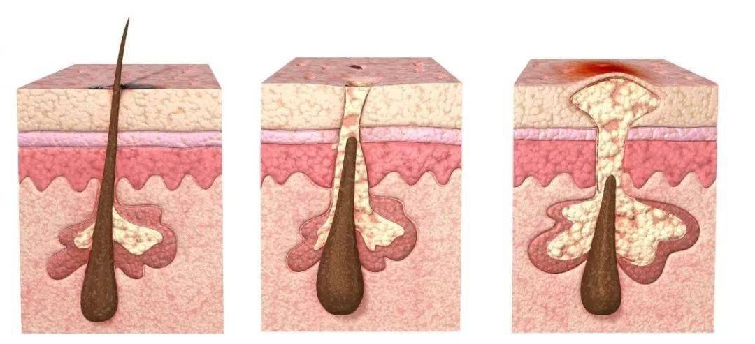 皮肤修复周期是多少天 b1ca9efcabb94bbdb249702aa87a7a00.jpeg