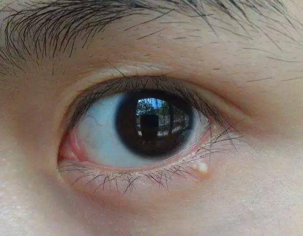 别以为只有近视度数较深的人才眼珠突出,比较常见的眼珠突出病因还有