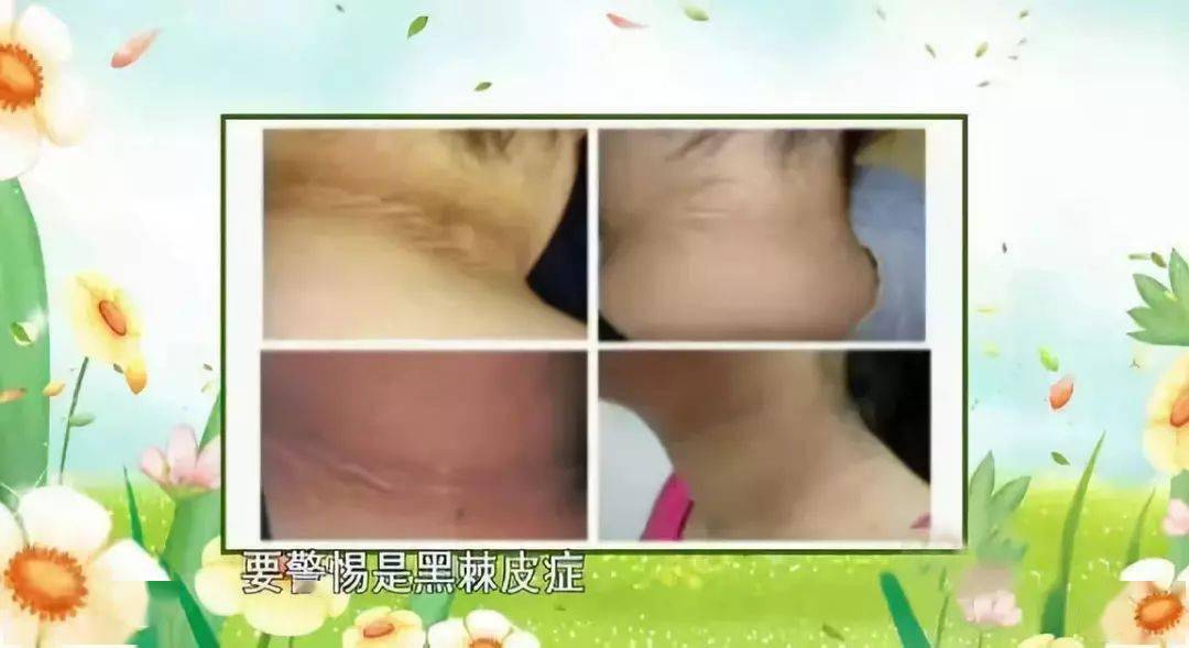 检测|糖尿病前期,对全身的损害已经开始!3个小物件1分钟帮你自测
