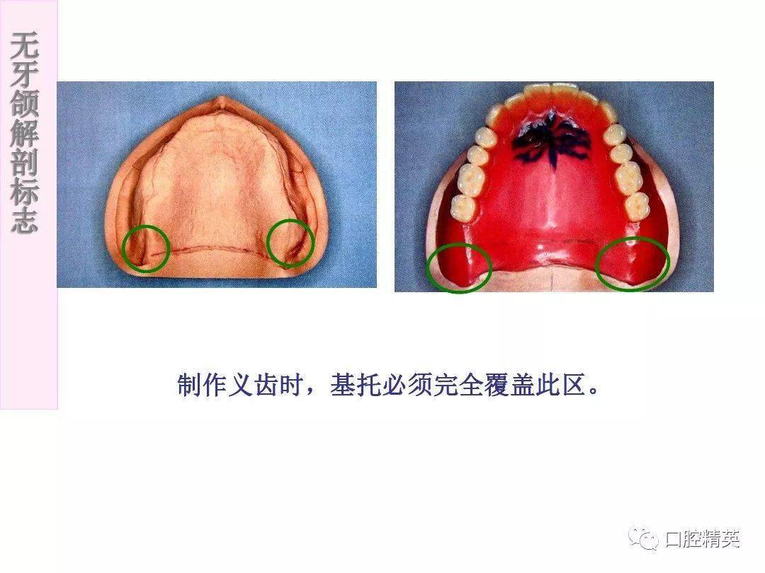 无牙颌解剖标志
