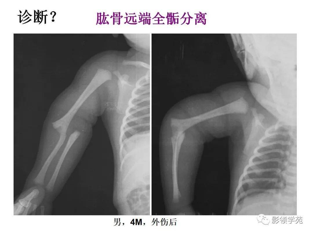 正确诊断:肱骨远端全骺分离儿童肘关节正常x线表现肱骨远端全骺分离指