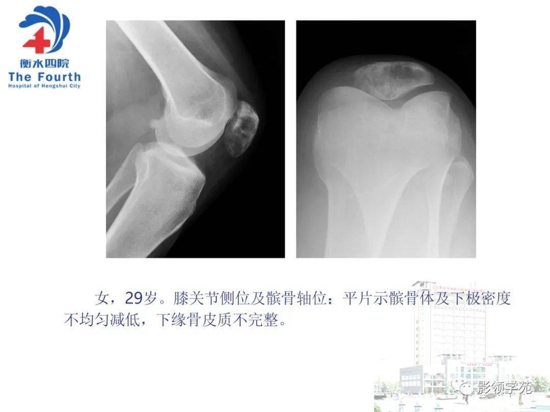 小结 1,髌骨肿瘤虽然少见,仔细观察影像学特征,再结合临床,大部分