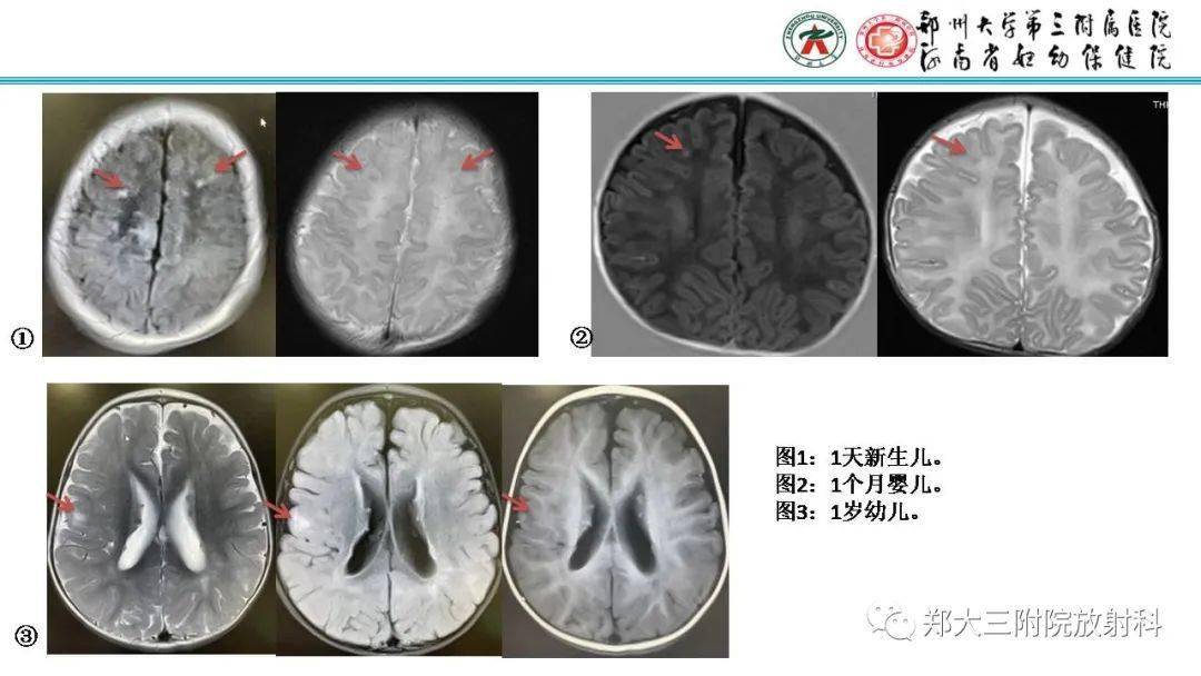 【zdzt100】新生儿及婴儿结节性硬化症的影像学表现