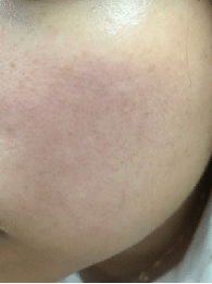 自救|皮肤敏感自救指南，找对原因才能轻松拯救！