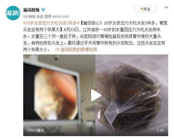 女童|10岁女孩压力大吃头发2年多 胃里头发足有两个苹果大