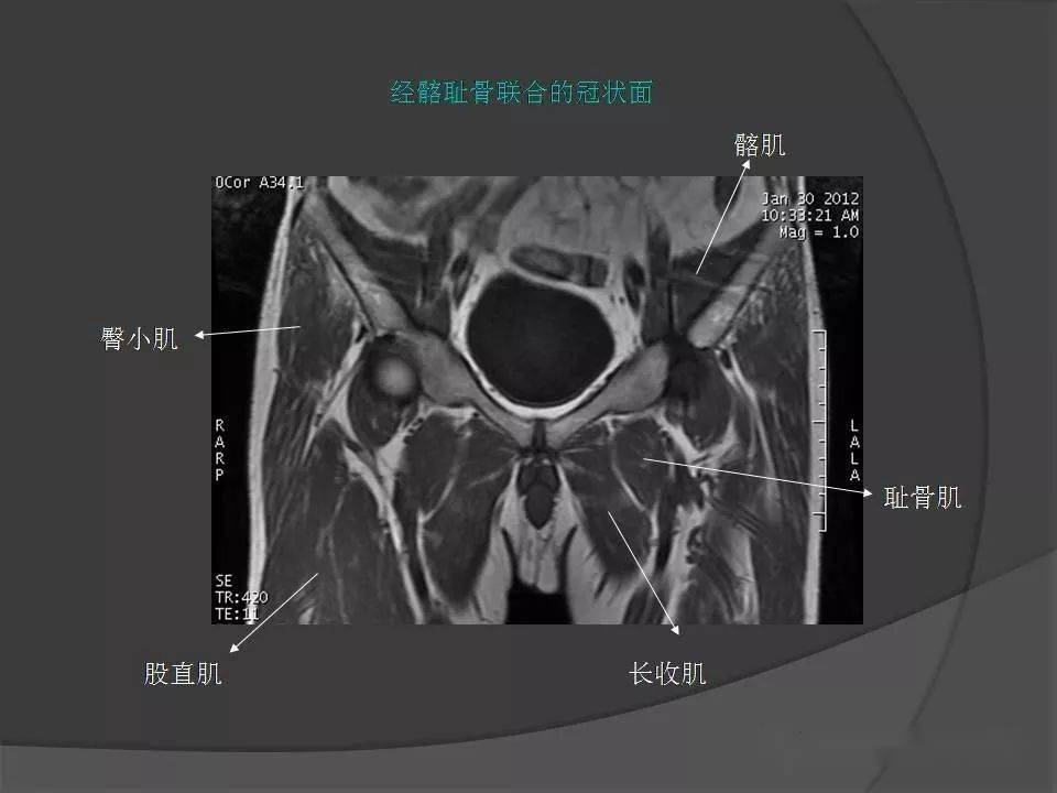 骨盆肌肉解剖mri标识