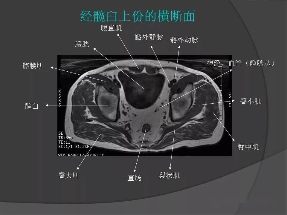 骨盆肌肉解剖mri标识