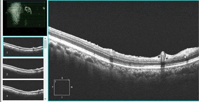 性别:男  年龄:73岁  主诉:右眼视物不清2年余 既往史:既往体健,2016