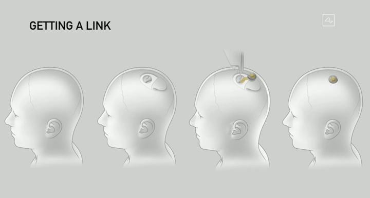 解读Neuralink最新脑机接口设备，3年内实现“人机共生”真有可能？