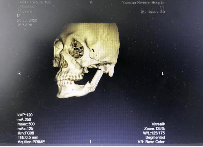 云县人民医院口腔科成功完成两例下颌骨部分切除术后非血管化骨移植整