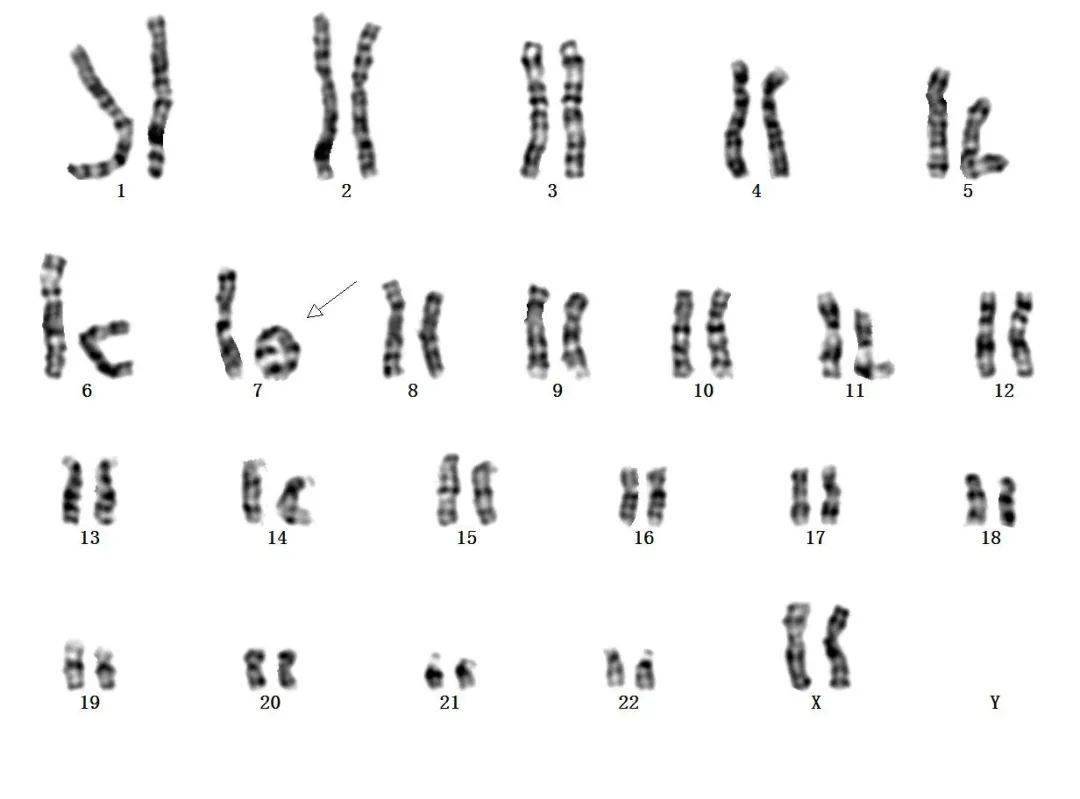 7号环状染色体(图 6 )染色体核型分析胎儿无叶型前脑无裂畸形伴颜面部