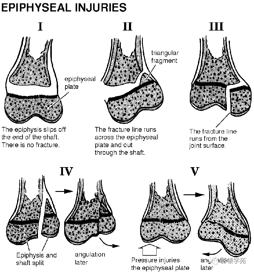 骨骺损伤分型