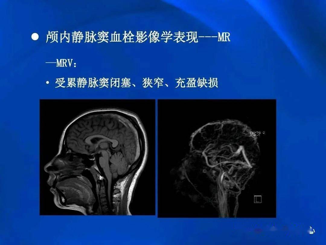 颅内静脉窦血栓形成的影像学表现