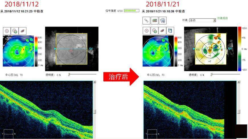 oct黄斑变化分析