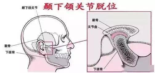 当牙医遭遇颞颌关节脱位的处理