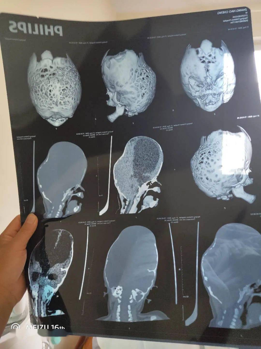 罕见疾病长春6个月宝宝头部畸形照片让人心痛