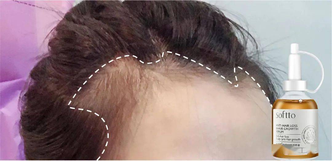 滋养液|32年才做成的育发液!让你挑战30天+生出小绒毛