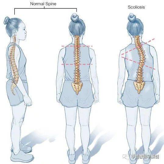 脊柱侧凸---给予那些备受困扰的人一些专业的建议