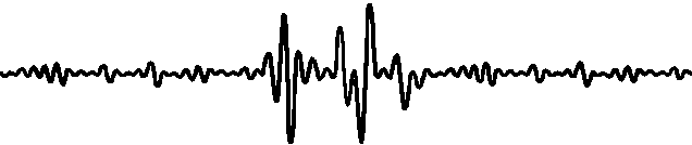 穿型|【前沿技术】先例！我院肾病科独立完成即穿型人工血管置入，大大改善透析患者的透析质量