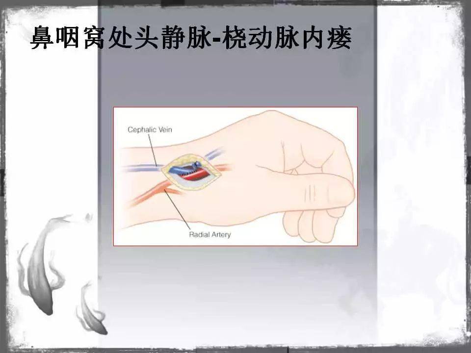 自体|血管通路 | 自体动静脉内瘘成形术