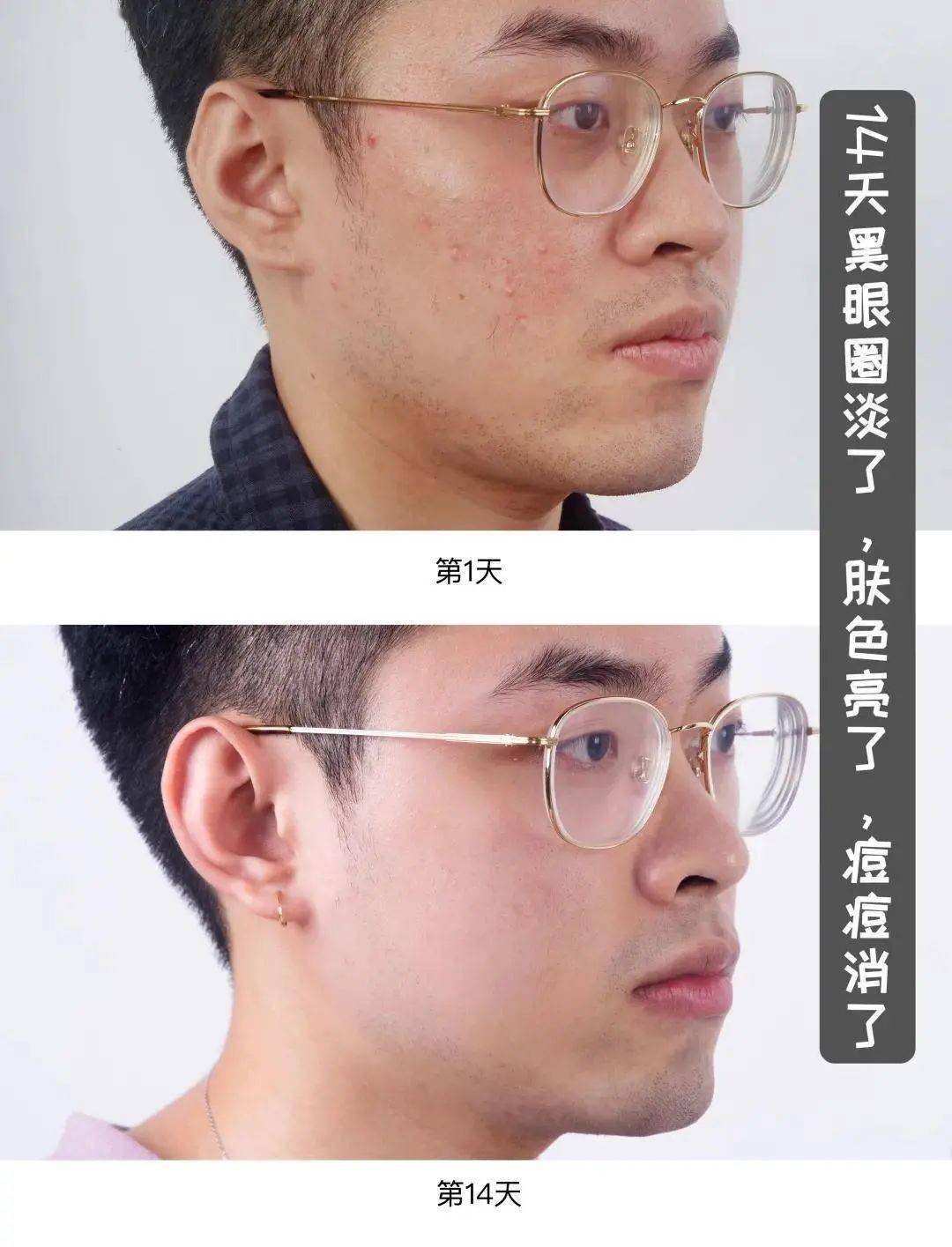 贫民窟|杨幂熬夜后护肤要花2万块？怪不得皮肤吹弹可破！贫民窟女孩就不配消除熬夜痘、黑眼圈吗？