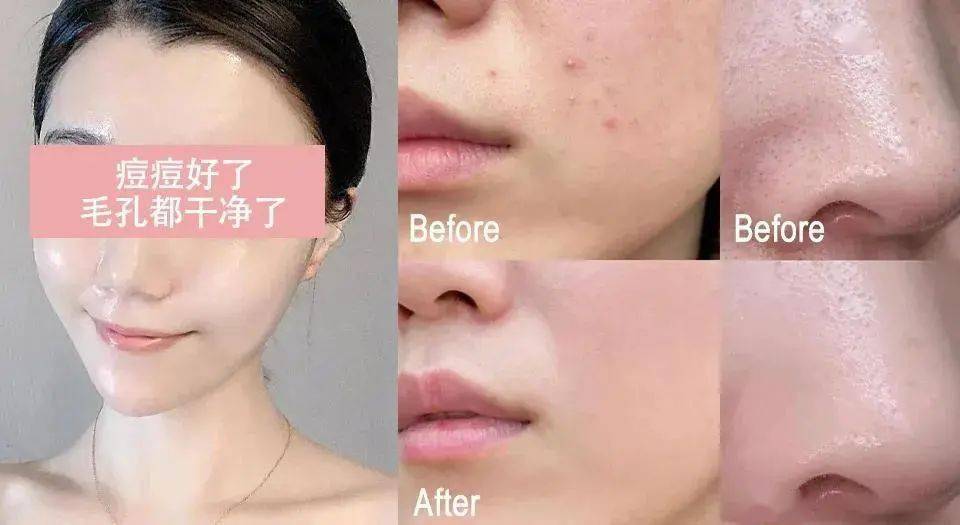 贫民窟|杨幂熬夜后护肤要花2万块？怪不得皮肤吹弹可破！贫民窟女孩就不配消除熬夜痘、黑眼圈吗？