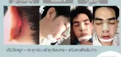 生活|泰国小哥花15万整形，成功从屌丝逆袭变男神！