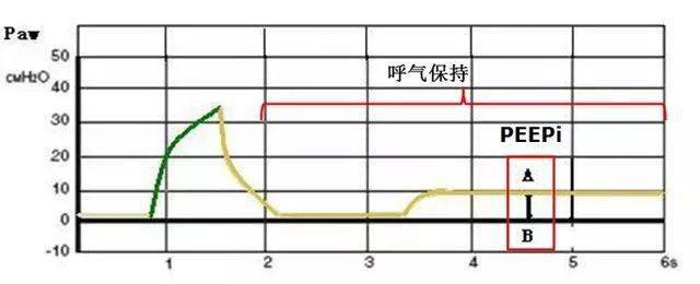 呼吸机上手指南:护士碰到呼吸机参数,不再慌!