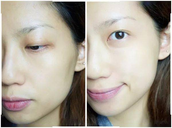 痘痘|夏天变黑长痘不可怕，赶紧用它，让你的皮肤恢复婴儿的光滑，痘痘，黑头，螨虫全都消失了