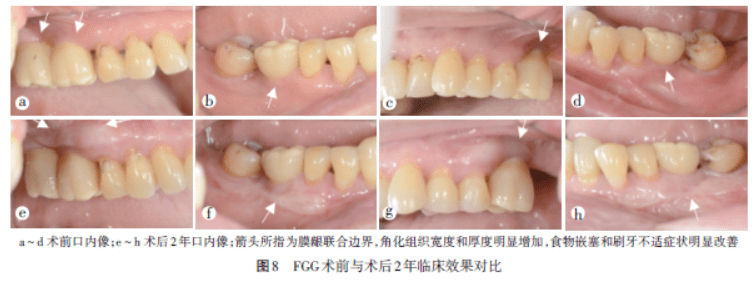 双侧上下后牙种植修复后应用游离龈移植术改善软组织条件利于健康维护