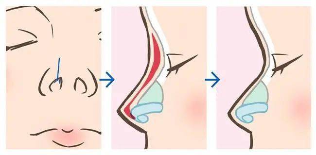 双眼皮|为什么“整容脸”女孩,更受直男欢迎?