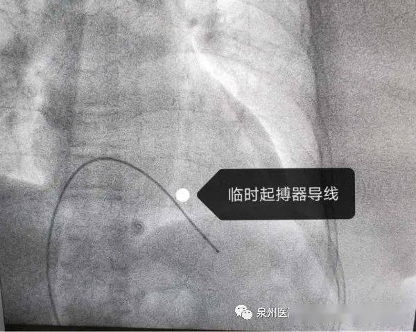 技术分享人民医院成功实施首例双腔心脏起搏器植入术