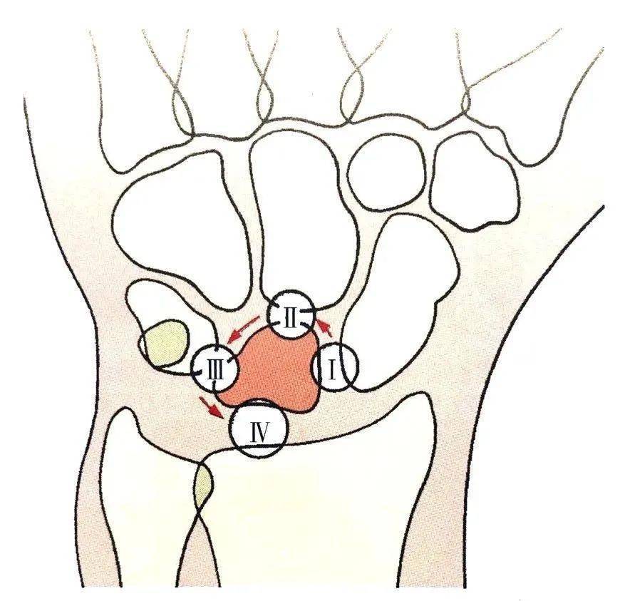 腕关节脱位及其x片阅读技巧_腕骨