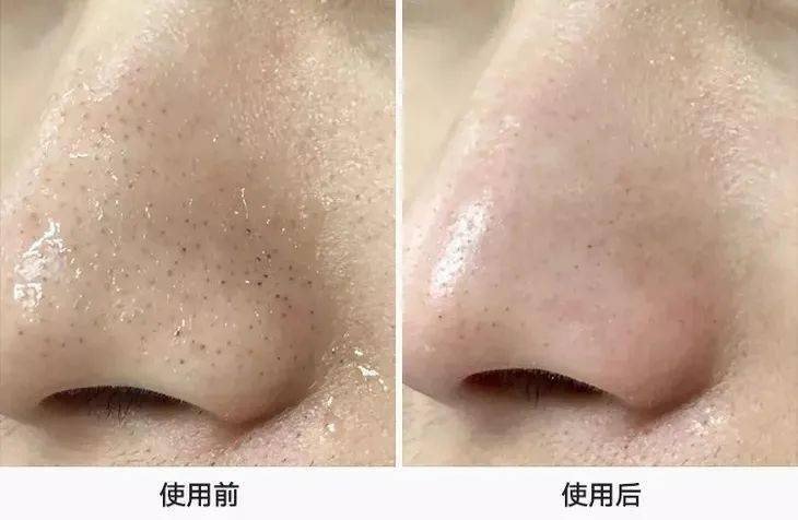 鼻子|米粒大的黑头，瞬间吸出，整个鼻子新生了！