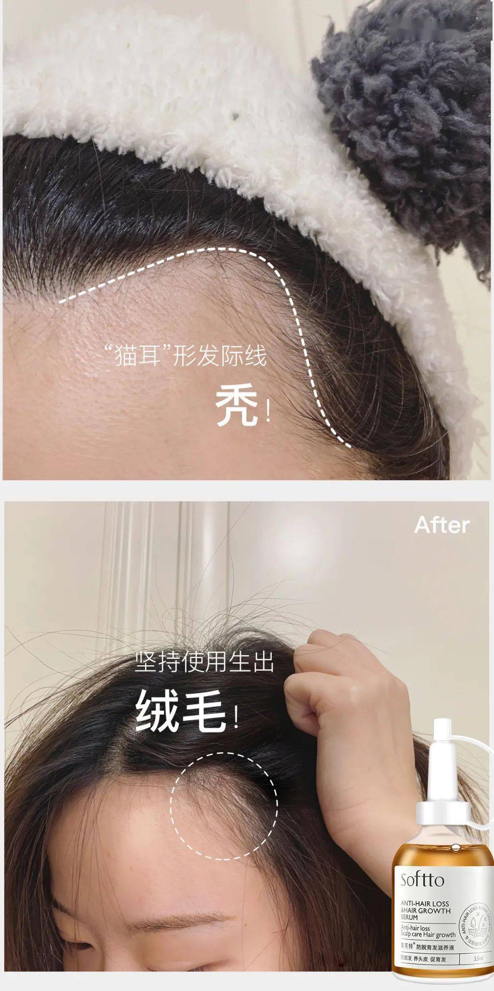 索芙特|超强国货生发!1个月发际线被填满,半年发量暴增!