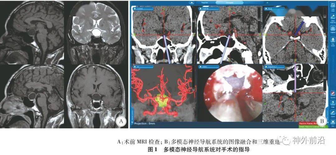 神经|多模态神经导航系统联合神经内镜在颅咽管瘤手术中的临床应用 | 临床神经外科