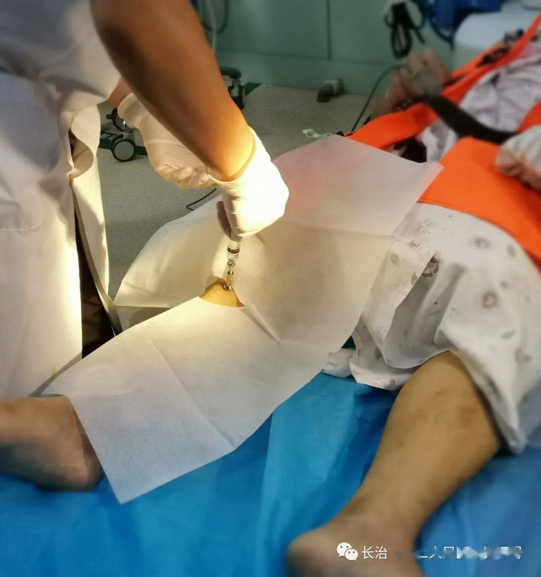 局麻下行骨髓腔穿刺