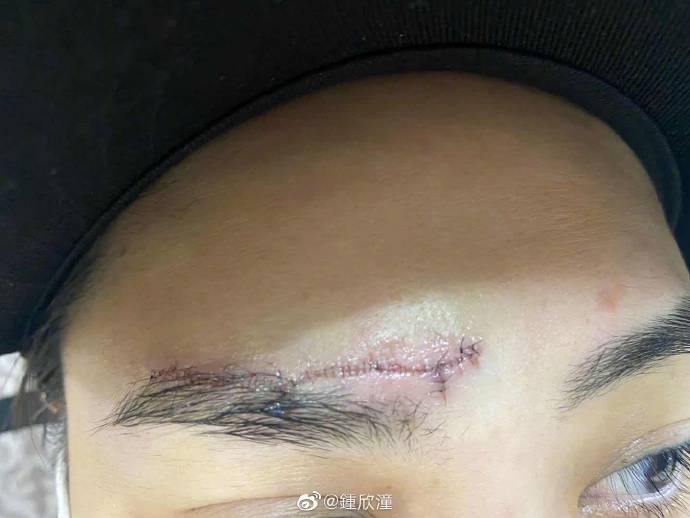 伤口|阿娇晒伤口照，疑回应炒作质疑