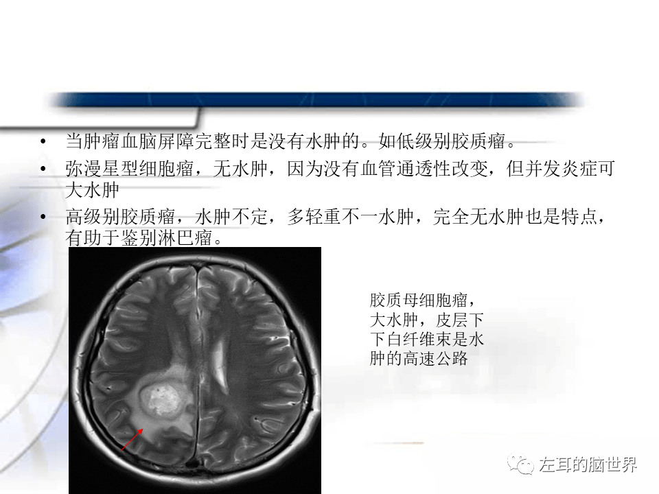 脑肿瘤基础 | 血脑屏障,强化,水肿