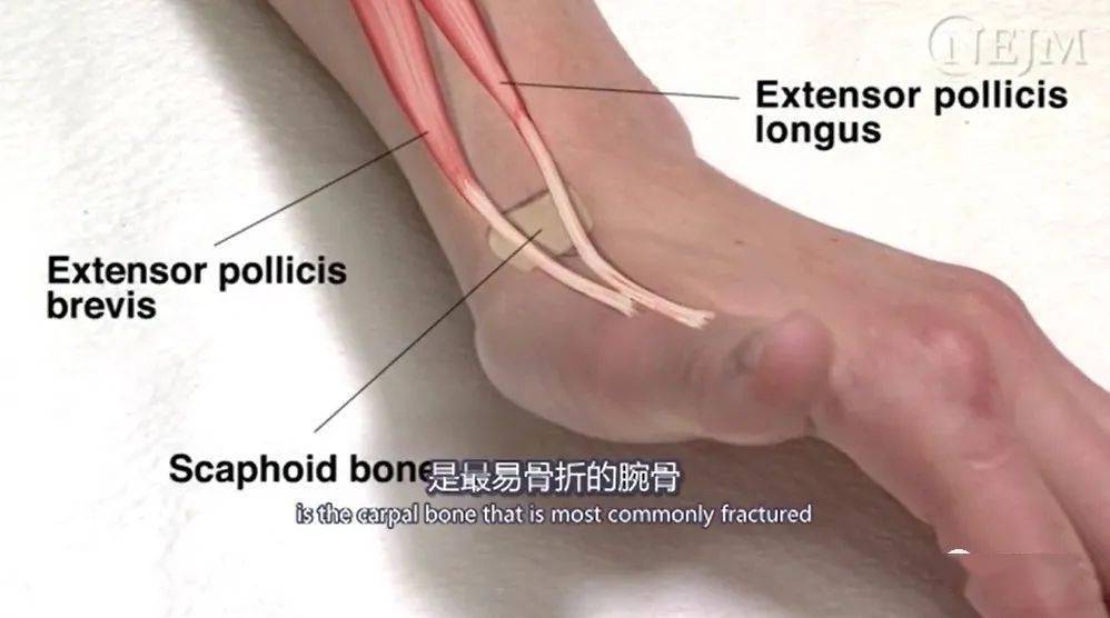 是最容易发生骨折的腕骨,所以要注意保护哟~  lister结节位于桡骨背侧