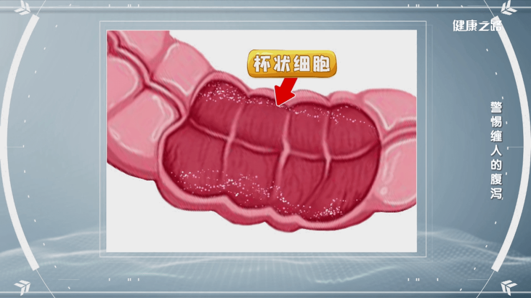 大便"预警"背后藏风险,不注意有可能引发癌变!