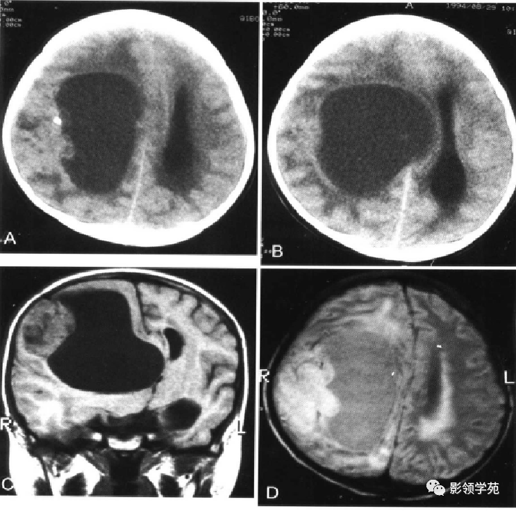 脑实质内囊性病变影像表现_囊虫