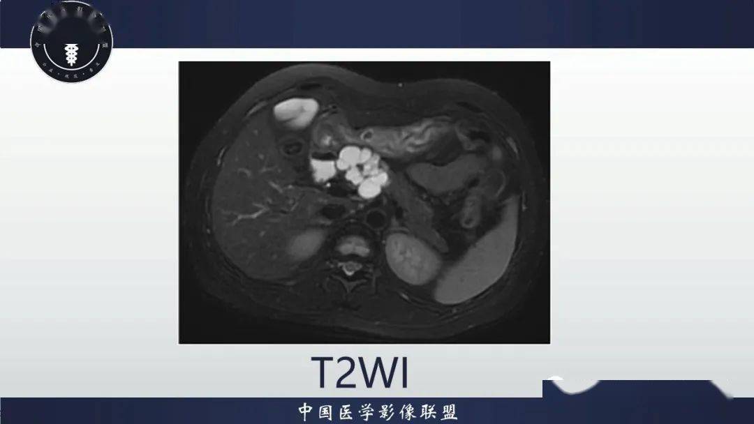 胰腺丨浆液性囊腺瘤黏液性囊腺瘤实性假乳头状肿瘤