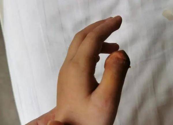 手指|手指保住了5岁女孩拇指被门夹断！妈妈做对这一步