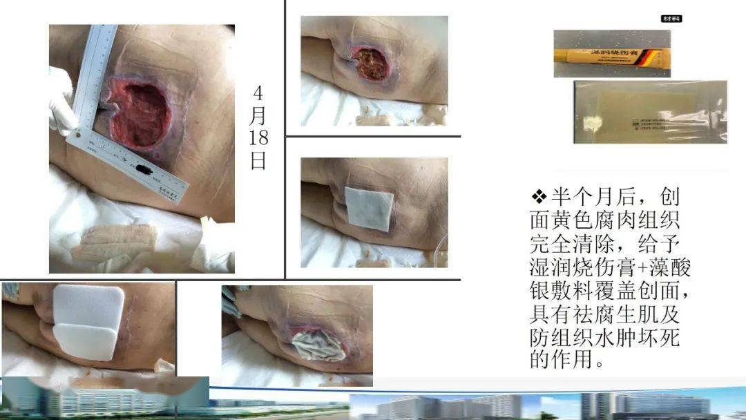 ppt一例慢性难治性压力性损伤患者的护理