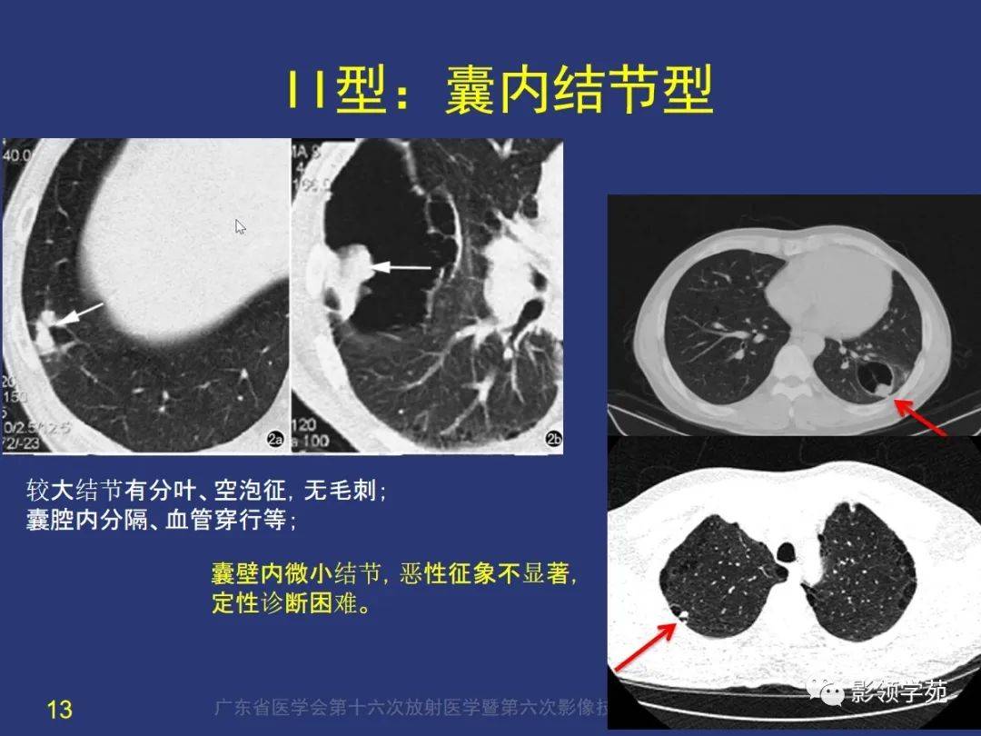 囊腔型肺癌的影像特征和鉴别