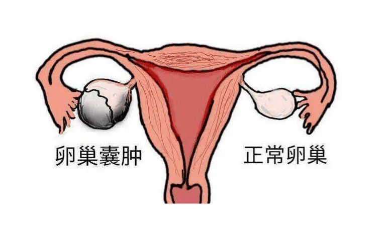 孕妇腹痛以为临产,原来是卵巢囊肿蒂扭转了