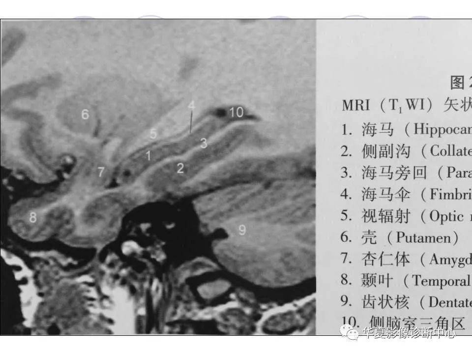海马解剖结构与海马硬化的mri诊断